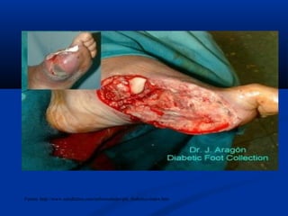 Fuente: http://www.saludlatina.com/enfermedades/pie_diabetico/index.htm
 