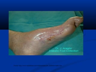 Fuente: http://www.saludlatina.com/enfermedades/pie_diabetico/index.htm
 