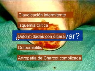 ¿Cuándo Derivar?
Claudicación intermitente
Isquemia crítica
Osteomielitis
Deformidades con úlcera
Artropatía de Charcot complicada
 