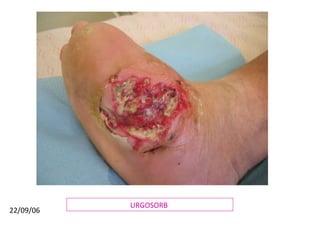 URGOSORB  22/09/06 