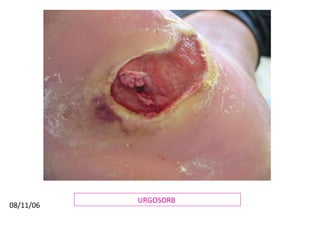 URGOSORB  08/11/06 