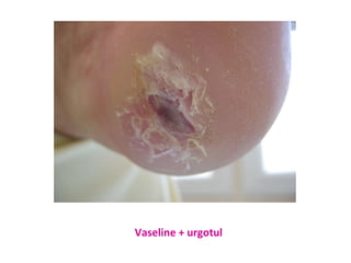 Vaseline + urgotul 