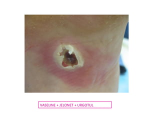 VASELINE + JELONET + URGOTUL 