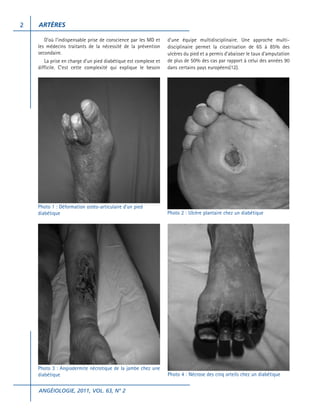 2

ARTÈRES
D’où l’indispensable prise de conscience par les MD et
les médecins traitants de la nécessité de la prévention
secondaire.
La prise en charge d’un pied diabétique est complexe et
difficile. C’est cette complexité qui explique le besoin

d’une équipe multidisciplinaire. Une approche multidisciplinaire permet la cicatrisation de 65 à 85% des
ulcères du pied et a permis d’abaisser le taux d’amputation
de plus de 50% des cas par rapport à celui des années 90
dans certains pays européens(12).

Photo 1 : Déformation ostéo-articulaire d’un pied
diabétique

Photo 2 : Ulcère plantaire chez un diabétique

Photo 3 : Angiodermite nécrotique de la jambe chez une
diabétique

Photo 4 : Nécrose des cinq orteils chez un diabétique

ANGÉIOLOGIE, 2011, VOL. 63, N° 2

 