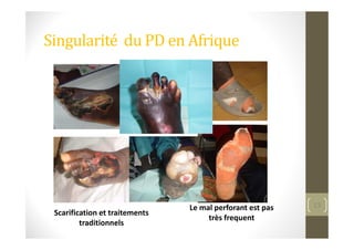 Singularité du PD en Afrique
13
Scarification et traitements
traditionnels
Le mal perforant est pas
très frequent
 
