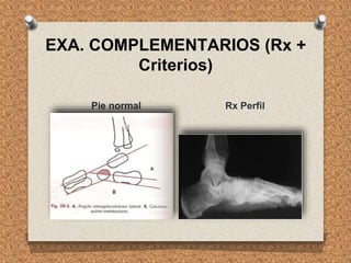 EXA. COMPLEMENTARIOS (Rx +
Criterios)
Pie normal Rx Perfil
 