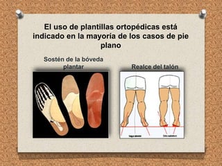 El uso de plantillas ortopédicas está
indicado en la mayoría de los casos de pie
plano
Sostén de la bóveda
plantar Realce del talón
 