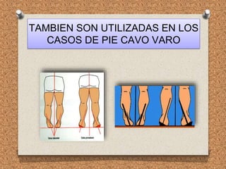 TAMBIEN SON UTILIZADAS EN LOS
CASOS DE PIE CAVO VARO
 
