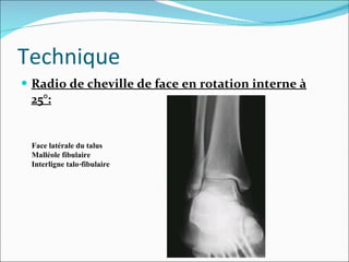 Radio de cheville de face en rotation interne à 25°: Technique Face latérale du talus Malléole fibulaire Interligne talo-fibulaire 