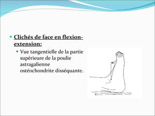 Clichés de face en   flexion-extension: Vue tangentielle de la partie supérieure de la poulie astragalienne  ostéochondrite disséquante.  