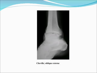 Cheville; oblique externe 