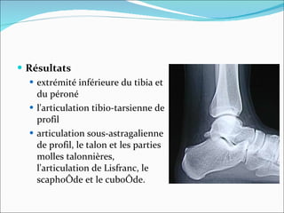 Résultats extrémité inférieure du tibia et du péroné l'articulation tibio-tarsienne de profil articulation sous-astragalienne de profil, le talon et les parties molles talonnières, l'articulation de Lisfranc, le scaphoïde et le cuboïde.  
