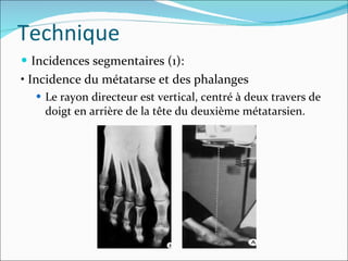 Incidences segmentaires (1): • Incidence du métatarse et des phalanges Le rayon directeur est vertical, centré à deux travers de doigt en arrière de la tête du deuxième métatarsien. Technique 