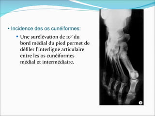 •  Incidence des os cunéiformes: Une surélévation de 10° du bord médial du pied permet de déﬁler l’interligne articulaire entre les os cunéiformes médial et intermédiaire.  