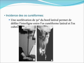 Une surélévation de 50° du bord latéral permet de déﬁler l’interligne entre l’os cunéiforme latéral et l’os cuboïde •  Incidence des os cunéiformes: 