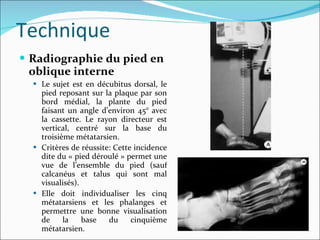 Radiographie du pied en oblique interne Le sujet est en décubitus dorsal, le pied reposant sur la plaque par son bord médial, la plante du pied faisant un angle d’environ 45° avec la cassette. Le rayon directeur est vertical, centré sur la base du troisième métatarsien. Critères de réussite: Cette incidence dite du « pied déroulé » permet une vue de l’ensemble du pied (sauf calcanéus et talus qui sont mal visualisés). Elle doit individualiser les cinq métatarsiens et les phalanges et permettre une bonne visualisation de la base du cinquième métatarsien. Technique 