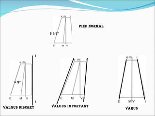 Pied normal Valgus discret Valgus important varus 8 à 9° > 9° i I 