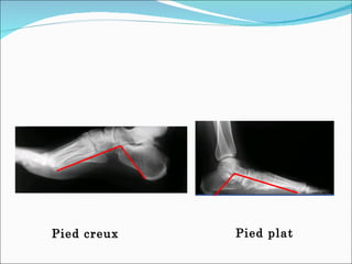 Pied creux Pied plat 