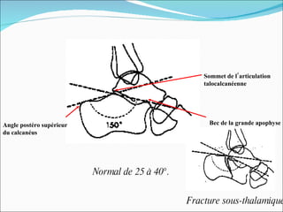 Fracture sous-thalamique. Normal de 25 à 40°. Sommet de l’articulation talocalcanéenne Bec de la grande apophyse Angle postéro supérieur du calcanéus 