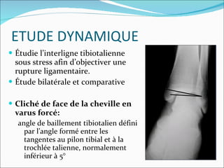 ETUDE DYNAMIQUE Étudie l’interligne tibiotalienne sous stress afin d’objectiver une rupture ligamentaire. Étude bilatérale et comparative Cliché de face de la cheville en varus forcé: angle de baillement tibiotalien défini par l’angle formé entre les tangentes au pilon tibial et à la trochlée talienne, normalement inférieur à 5° 