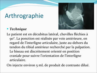 Arthrographie Technique Le patient est en décubitus latéral, chevilles fléchies à 90°. La ponction est réalisée par voie antérieure, en regard de l’interligne articulaire, juste au-dehors du tendon du tibial antérieur recherché par la palpation. Le biseau est discrètement orienté en position craniale pour suivre l’orientation de l’interligne articulaire. On injecte environ 5 mL de produit de contraste dilué. 