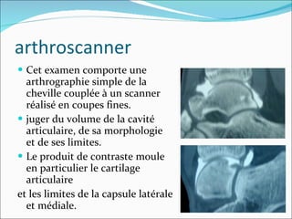 arthroscanner Cet examen comporte une arthrographie simple de la cheville couplée à un scanner réalisé en coupes fines. juger du volume de la cavité articulaire, de sa morphologie et de ses limites. Le produit de contraste moule en particulier le cartilage articulaire et les limites de la capsule latérale et médiale. 