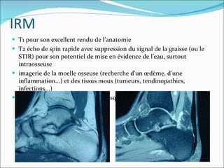 IRM T1 pour son excellent rendu de l’anatomie T2 écho de spin rapide avec suppression du signal de la graisse (ou le STIR) pour son potentiel de mise en évidence de l’eau, surtout intraosseuse imagerie de la moelle osseuse (recherche d’un œdème, d’une inflammation...) et des tissus mous (tumeurs, tendinopathies, infections...)  Elle constitue un complément presque parfait du scanner 