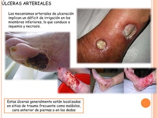 ÚLCERAS ARTERIALES
Los mecanismos arteriales de ulceración
implican un déficit de irrigación en los
miembros inferiores, lo que conduce a
isquemia y necrosis.
Estas úlceras generalmente están localizadas
en sitios de trauma frecuente como maléolos,
cara anterior de piernas o en los dedos