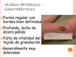 ULCERAS ARTERIALES :
CARACTERÍSTICAS
Forma regular con
bordes bien definidos
Profunda, lecho de
úlcera pálido
Falta de vitalidad del
tejido de granulación
Generalmente muy
dolorosas