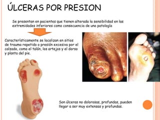 ÚLCERAS POR PRESION
Se presentan en pacientes que tienen alterada la sensibilidad en las
extremidades inferiores como consecuencia de una patología
Característicamente se localizan en sitios
de trauma repetido o presión excesiva por el
calzado, como el talón, los artejos y el dorso
y planta del pie.
Son úlceras no dolorosas, profundas, pueden
llegar a ser muy extensas y profundas.