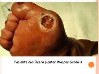 Paciente con úlcera plantar Wagner Grado 3