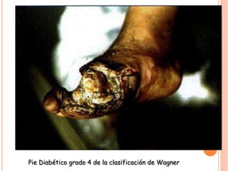 Pie Diabético grado 4 de la clasificación de Wagner