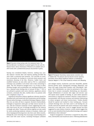 FOOT AND ANKLE




Figure 2 Sensation being testing under the metatarsal heads. The
Semmes-Weinstein monofilament is pressed against the skin until the
filament bends. Various thicknesses of filaments are available each of
which bends with a predetermined pressure documented in grams.


bearing was considered helpful, however, walking may actu-
ally improve vascular flow and improve healing provided the                   Figure 3 Photograph illustrating a typical plantar ulceration seen
ulcer itself is protected from pressure. TCC provides an excel-               in diabetic feet. The pressure area has become necrotic exposing
lent environment for healing as it prevents point pressure and                granulation tissue without significant infection or tendon/bone
minimizes shearing of the skin. However, walker boots and                     exposure (Wagner 1). This is best treated by orthotics and offloading.
modified footwear are also often used as TCC is a specialized
technique not available in all centres and is time consuming to               and collagen matrix), hyaluronic acid ester (Hyalofill), platelet
apply. The TCC should be changed every 5 to 14 days to allow                  derived growth factor impregnated dressings (Regranex) and
dressing changes and accommodate any swelling problems and                    those that apply living foetal foreskin cells (Dermagraft, Apli-
has a reported mean healing time of around 39 days.7,8 TCC is                 graft). Ulcer debridement can often be performed in the outpa-
not advised in patients with active infection, significant arterial           tients due to sensory neuropathy diminishing any discomfort.
occlusion, extremely thin skin, swollen skin or in patients with              Simple debridement of necrotic skin edges and necrotic caps
poor compliance (Figure 4).                                                   will expose tissue capable of healing. In cases where operative
    Superficial ulcerations without significant infection should be           intervention is required for extensive infection a long incision is
identified early and treated with ulcer preparation and off-­loading.         recommended, with Brunner incisions and minimal undermining
Normal saline dressings, or absorbent dressings (Alignate, Hydro-             to reduce iatrogenic soft tissue traction/injury. Tendon sheaths
fibre etc) are often all that is required. Occlusive hydrocolloids,           should be opened and washed to clear tracking pus. Vacuum
hydrogels or hypertonic saline gels can help remove necrotic tis-             assisted dressings have also been used to aid healing but are
sue, with the Cochrane systematic review suggesting that avail-               usually reserved for patients with ulcers resistant to more simple
able trials favour the use of hydrogel dressings for the removal              measures or for large areas. Laval or maggot therapy has been
of slough and callus.9 Foams and calcium alginate are also useful             suggested by some authors, however, review articles suggest this
for ulcers producing moderate volumes of exudates. Iodine and                 to be no more beneficial than hydrocolloid dressings and surgical
silver impregnated dressings have also been used. More recently,              debridement when indicated.9
biologically active dressings that encourage wound healing have                  Surgical management of ulceration is required for deep infec-
been used with some success, including Promogran (cellulose                   tions, osteomyelitis and recalcitrant ulcers. Following debridement


ORTHOPAEDICS AND TRAUMA 23:1                                             64                                             © 2008 Elsevier Ltd. All rights reserved.
 