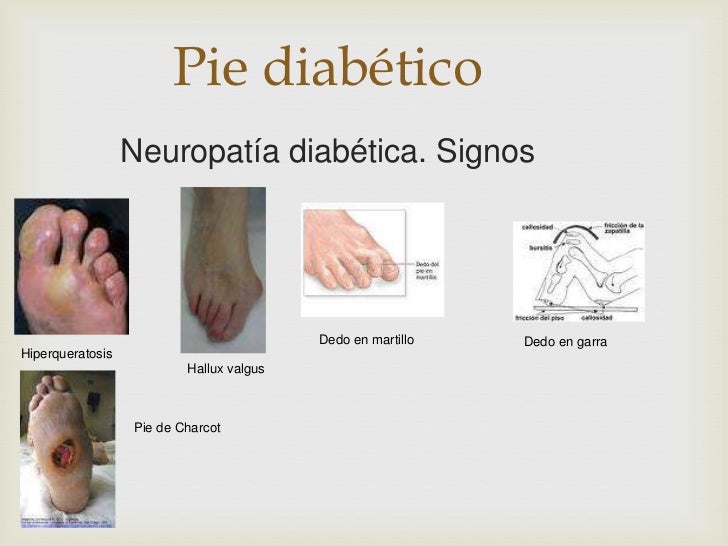 ¿Callo o úlcera de pie diabético? Pacientes reales ¿Callo o úlcera de pie diabético? Pacientes reales