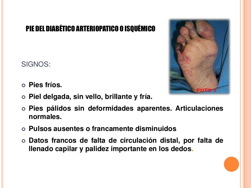 Pie diabetico