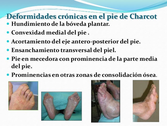 Pie diabetico Pie diabetico