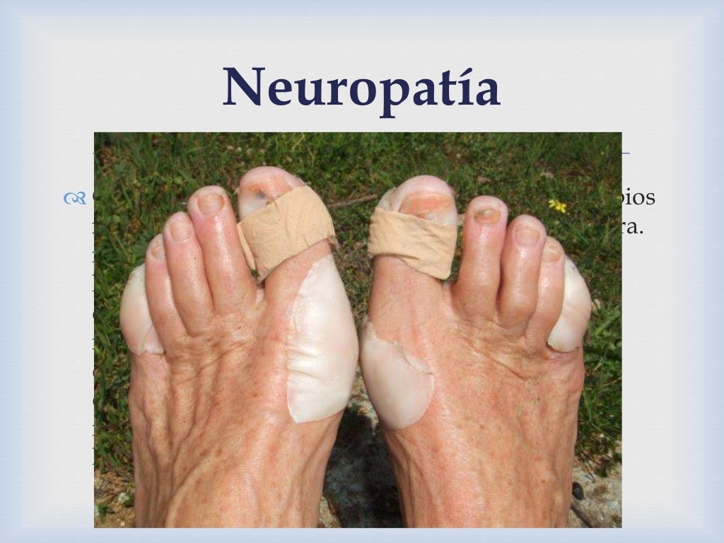 Pie diabético en México 2014