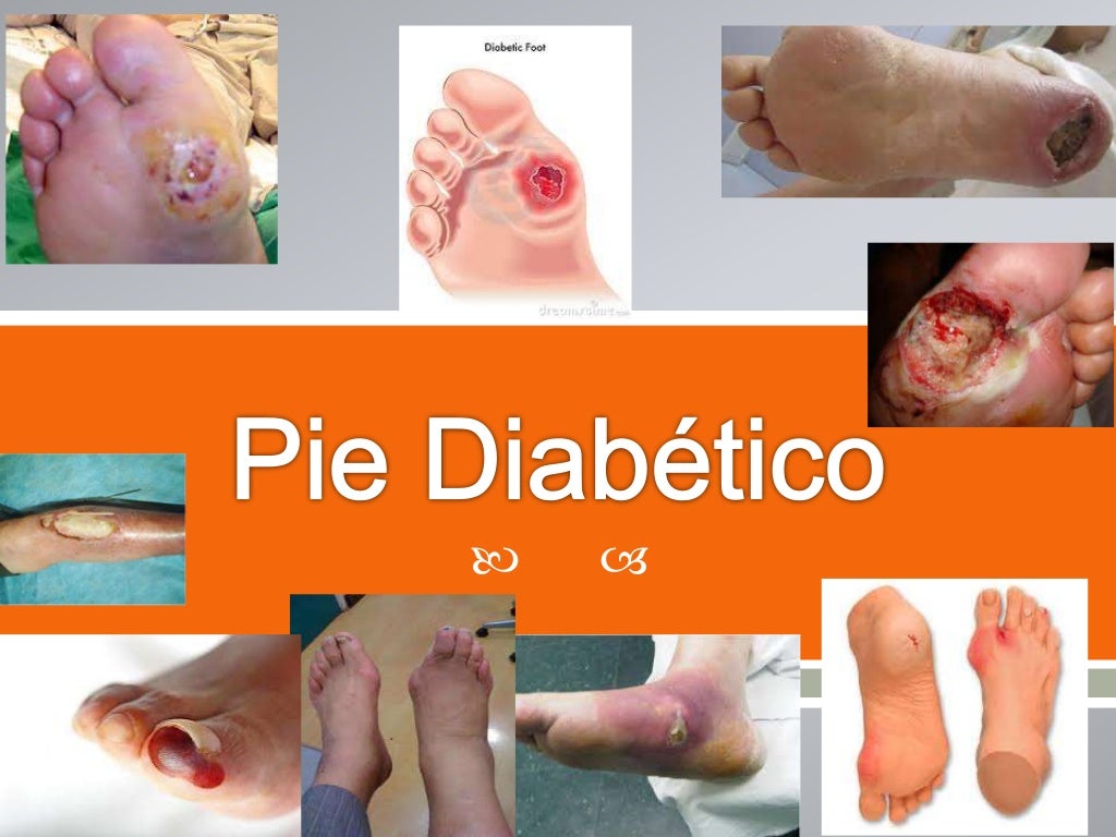 Pie diabetico