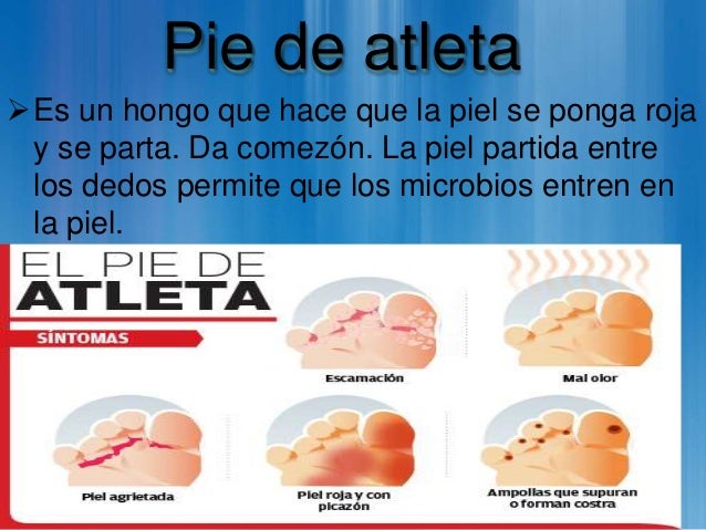 Los modos se librará del hongo sobre las uñas