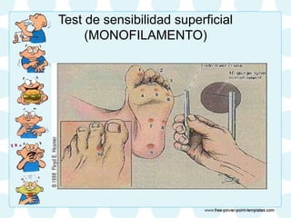 Test de sensibilidad superficial
(MONOFILAMENTO)
 