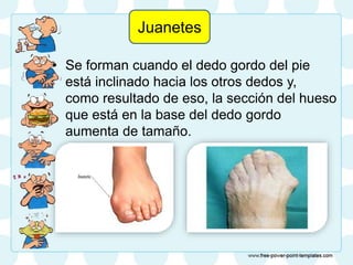• Se forman cuando el dedo gordo del pie
está inclinado hacia los otros dedos y,
como resultado de eso, la sección del hueso
que está en la base del dedo gordo
aumenta de tamaño.
Juanetes
 