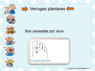 Verrugas plantares
Son causadas por virus
 