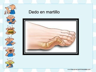 Dedo en martillo
 
