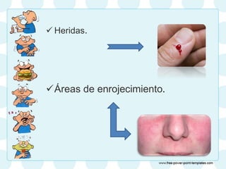  Heridas.
Áreas de enrojecimiento.
 