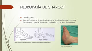 NEUROPATÍA DE CHARCOT
 La más grave.
 Alteración osteoarticular, los huesos se debilitan hasta el punto de
fracturarse. El pie se deforma con el tiempo y el arco desaparece.
Fuente: Programa Formativo para enfermería. Pie diabético y manejo del dolor neuropático de Lilly
Fuente: www.estudiabetes.com
 