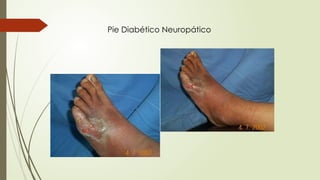 Pie Diabético Neuropático
 