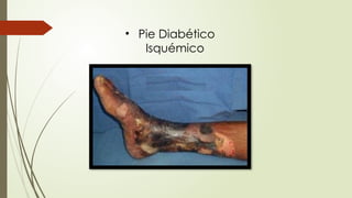 • Pie Diabético
Isquémico
 