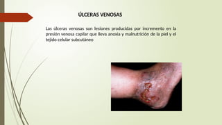 ÚLCERAS VENOSAS
Las úlceras venosas son lesiones producidas por incremento en la
presión venosa capilar que lleva anoxia y malnutrición de la piel y el
tejido celular subcutáneo
 
