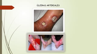 ÚLCERAS ARTERIALES
 