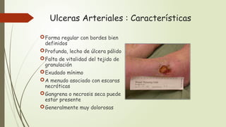 Ulceras Arteriales : Características
Forma regular con bordes bien
definidos
Profunda, lecho de úlcera pálido
Falta de vitalidad del tejido de
granulación
Exudado mínimo
A menudo asociado con escaras
necróticas
Gangrena o necrosis seca puede
estar presente
Generalmente muy dolorosas
 